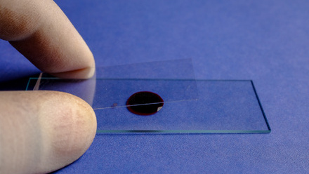 Preparing blood smear on slide for microscopic examination