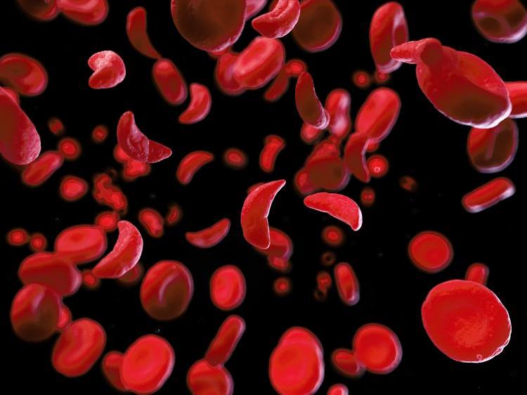 sickle-cell-blood-cells.jpg