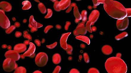 sickle-cell-blood-cells.jpg