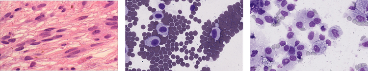 Cytospins of the biopsies are prepared and reviewed by our specialist pathologist for pathological confirmation
