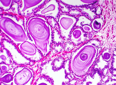 Histopathology slide of prostate gland hyperplasia