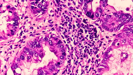 Core biopsy of prostate gland showing adenocarcinoma
