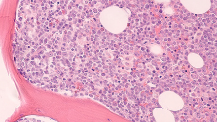 Bone marrow biopsy showing myeloblasts of acute myeloid leukemia (AML)