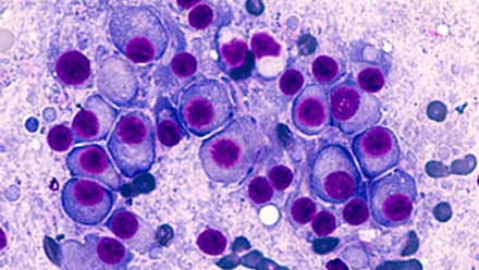 Microscopic image of multiple myeloma