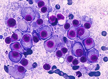 Microscopic image of multiple myeloma