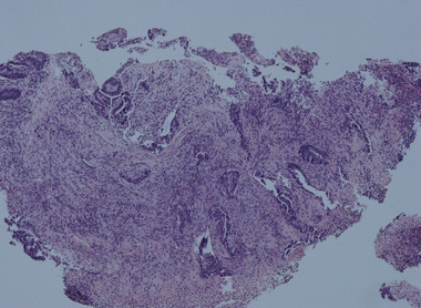 H&E section of a colonic biopsy showing a malignant tumour (adenocarcinoma)