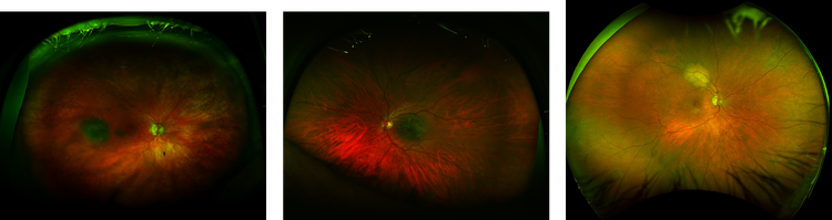 Multimodal comparison of three choroidal lesions