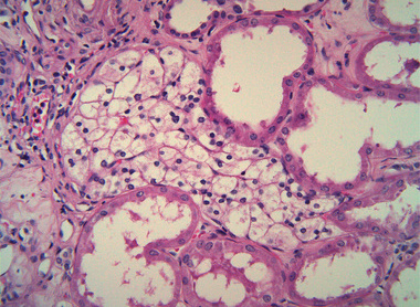 Kidney with a small focus of clear cell renal cell carcinoma in between renal tubules_low res.jpg