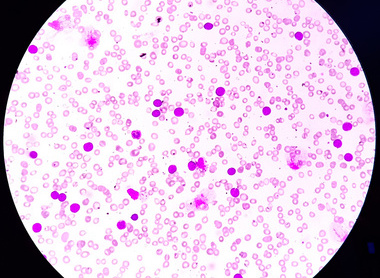 Microscopic slide showing acute lymphoblastic leukaemia.jpg