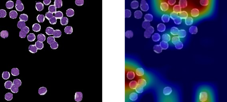  Example of the same tile of uveal melanoma patient, pre- and post-classification