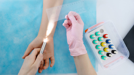 Doctor doing skin allergy test