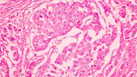 Ductal cell carcinoma in breast tissue