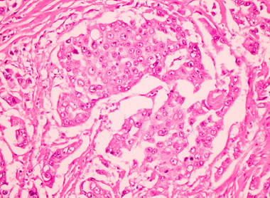 Ductal cell carcinoma in breast tissue