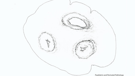 Incredible You_Paediatric and perinatal pathology: Umbilical cord tissue