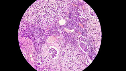 Breast cancer awareness Microscopic image (photomicrograph) of core biopsy for infiltrating (invasive) ductal carcinoma_lower res for web.jpg