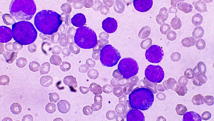 Peripheral blood smear showing cancer cells (AML)