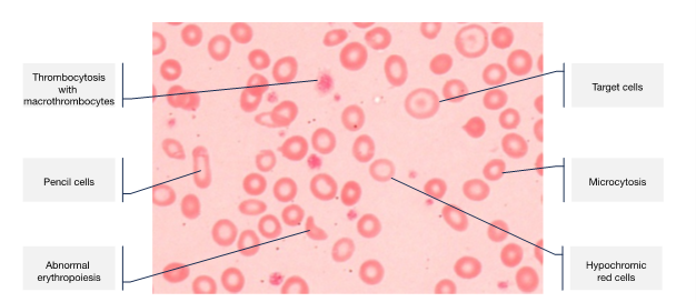 Typical blood film features of iron deficiency anaemia