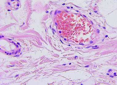 Colon cancer microscopic photograph